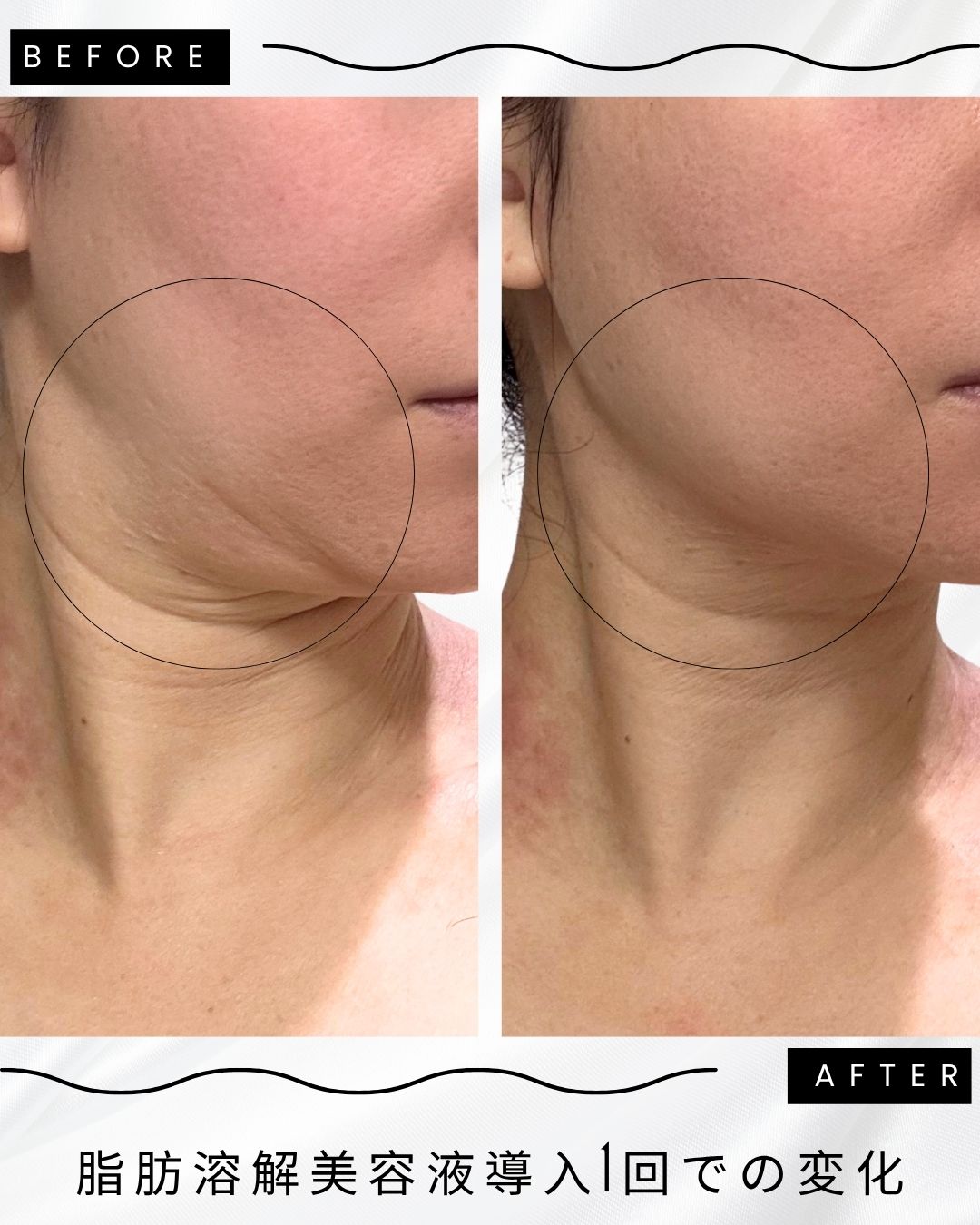 脂肪溶解下北沢