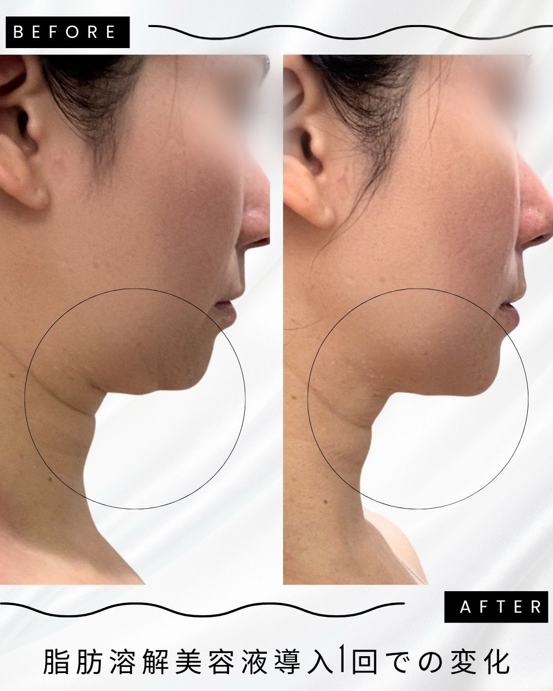 脂肪溶解下北沢